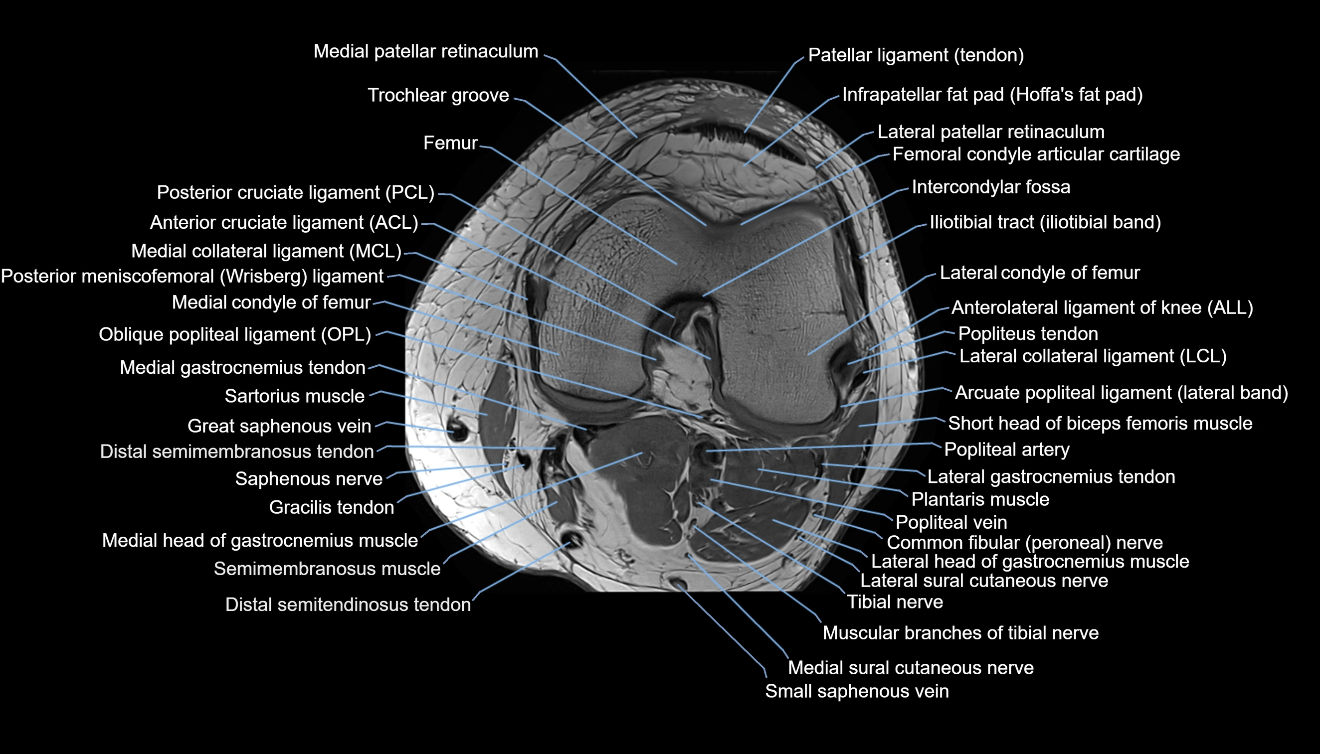 MRI knee  axial cross sectional anatomy 3T radiology  image-img-00001-00024.webp